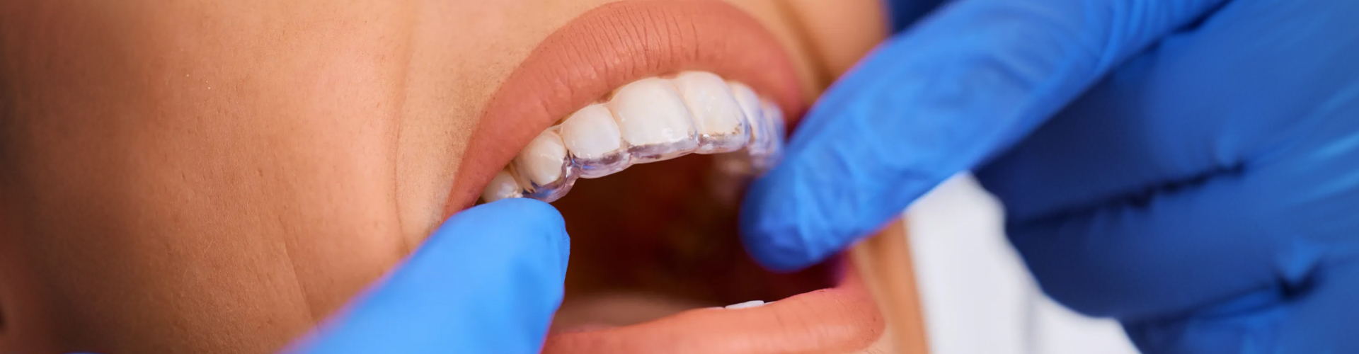 Close-up of a patient wearing a clear orthodontic aligner while a dental professional checks the fit with gloved hands.